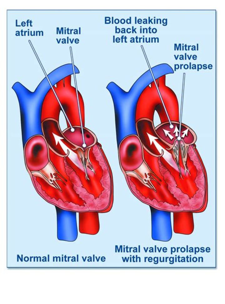 Carol Barr’s Death At 39: Why Floppy Valve Syndrome Killed Her Even Though It’s ‘Not Usually’ Fatal — Cardiologists
