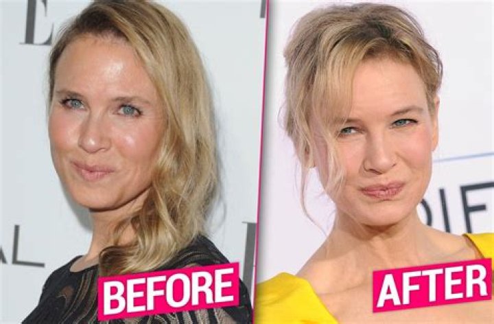 Renee Zellweger Speaks Out About Her Plastic Surgery In New Interview